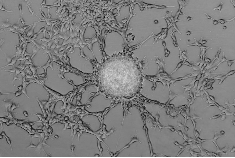Ovarian patient derived cancer spheroid co-cultured with cancer-associated fibroblasts