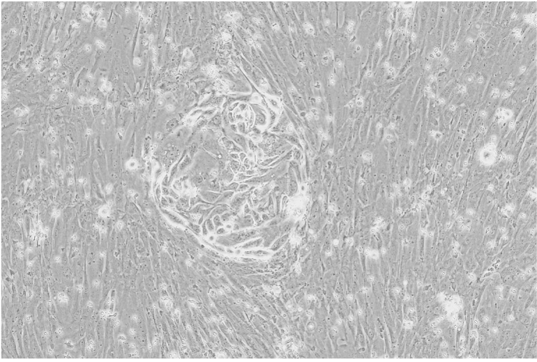 Representative brightfield microscope image of a three-dimensional ovarian patient derived cancer spheroid co-cultured with cancer-associated fibroblasts.